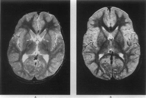 Reversal Of Early Neurologic And Neuroradiologic Manifestations Of X