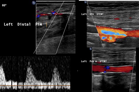 Thrombolysis Of Bypass Graft Radiology Wales