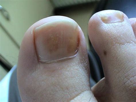 PSORIASIS - Psoriatic nails picture | Hellenic Dermatological Atlas ...