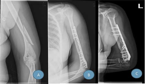 Figure 1 From Comparison Of Lateral And Posterior Surgical Approach In