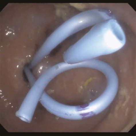 Endoscopic View Of The Two 7f 4 Cm Long Double Pigtail Stents Placed