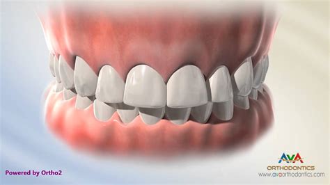 Orthodontic And Restorative Treatment For Small Or Peg Lateral Incisor