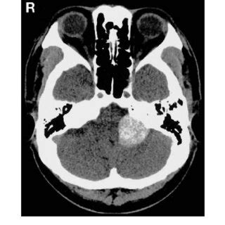 Computed Tomography Scan Without Contrast Enhancement Showing A