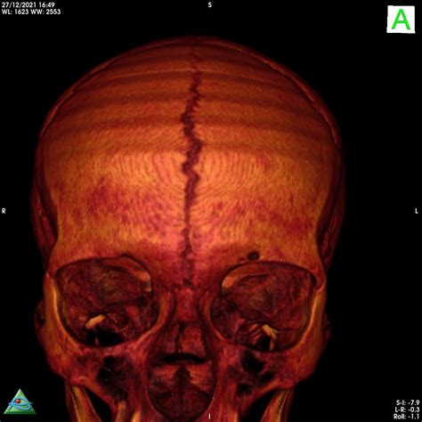 Persistent Metopic Suture Neurorad911 Persistent Metopic Suture