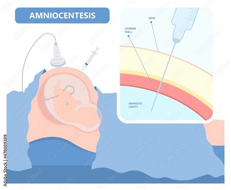 Amniocentesis Diagnostic Test Treat Lab Analysis Dna Gene Screen Risk