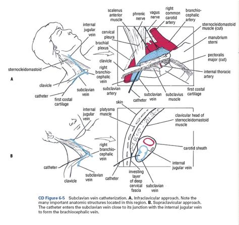 Subclavian Vein Catheterization