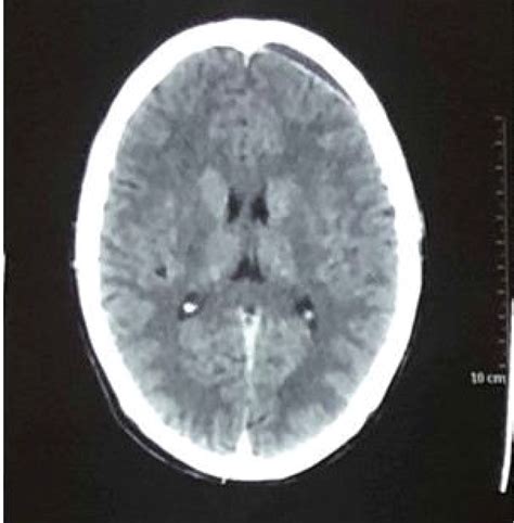 Resolution Of Asymptomatic Significant Volume Extradural Haematoma On