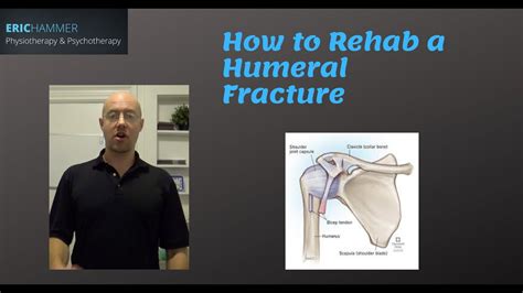 Proximal Humerus Fracture Exercises