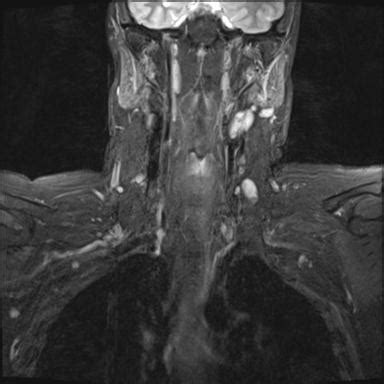 Brachial Plexus Traction Injury Image Radiopaedia Org