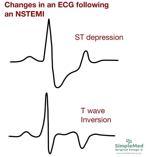 10 Electrocardiogram Pathology SimpleMed Learning Medicine Simplified