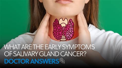 What Are The Early Symptoms Of Salivary Gland Cancer Otolaryngology