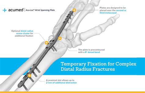 Hand Wrist Acumed Information