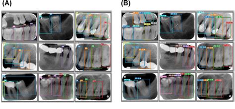 Figure From Automatic Recognition Of Teeth And Periodontal Bone Loss