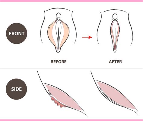 Labiaplasty Cosmetic And Plastic Surgeon In Lahore