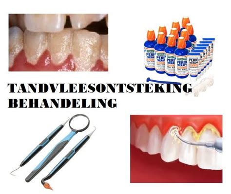 Tandvleesontsteking 10 Tips Oorzaken En Behandeling