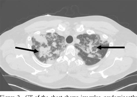 Acute Eosinophilic Pneumonia Radiology Reference Article