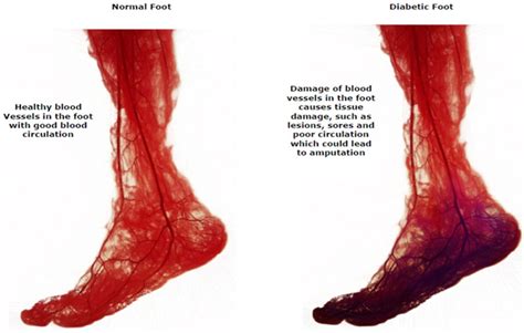 Diabetic Foot Ulcers - Nursing CE Central