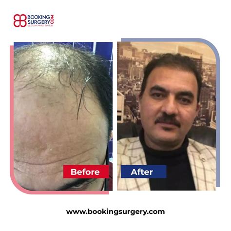 Hair Transplant Before and After Photos