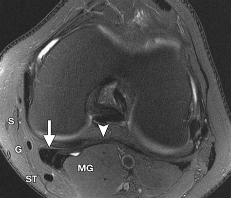 Oblique Popliteal Ligament Mri