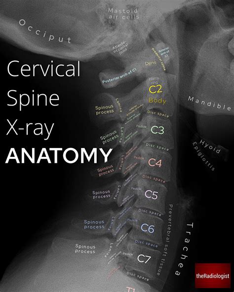 Theradiologist On Twitter C Spine Ct Has Been Shown To Be A More