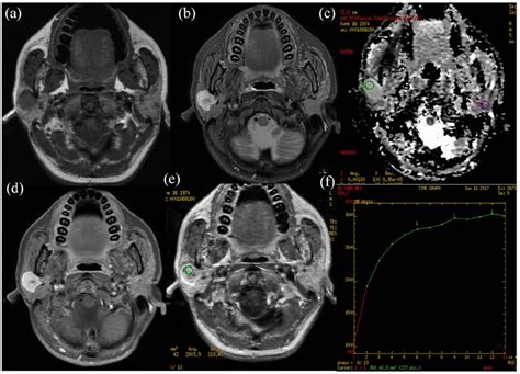 Pleomorphic Adenoma Of The Right Parotid Gland In A 43 Year Old Female