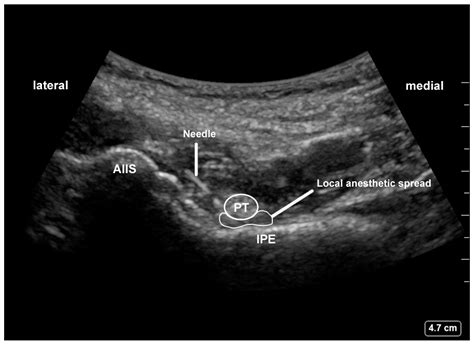 Ilioinguinal Nerve Block Ultrasound