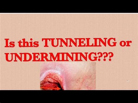 Wound Care Tunneling Versus Undermining Youtube