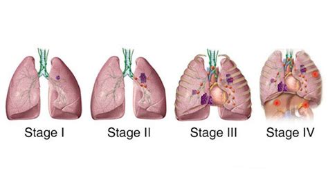 Staging Of Lung Cancer Chart