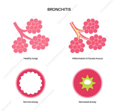 Bronchitis Lung Disease Illustration Stock Image F040 2789 Science Photo Library