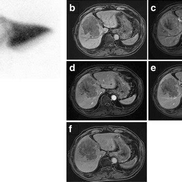 Mtc Dtpa Galactosyl Human Serum Albumin Gsa Liver Scintigraphy