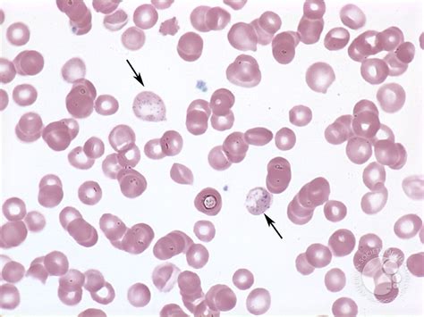 Basophilic stippling - 1.