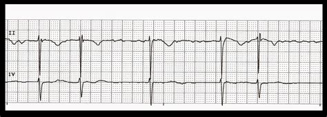 Practice EKG Strips 340