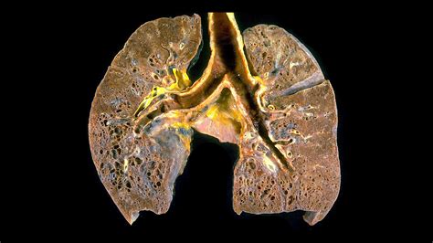 Interstitial Lung Diseases - StoryMD