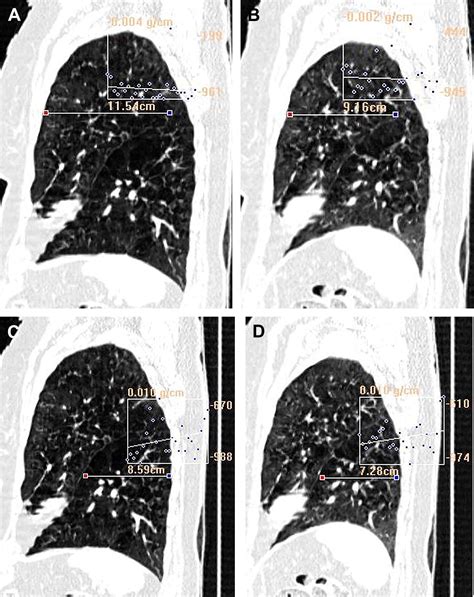 Volumetric Expiratory Hrct Of The Lung Clinical Applications