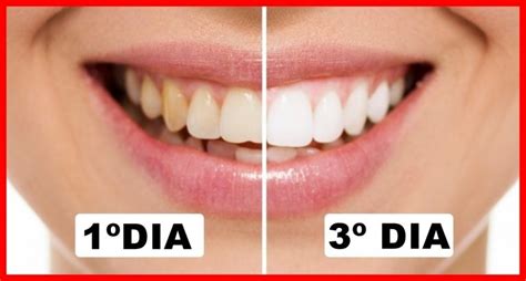 As 10 Dicas Para Clarear Os Dentes Em 3 Dias Celeiro Do Brasil