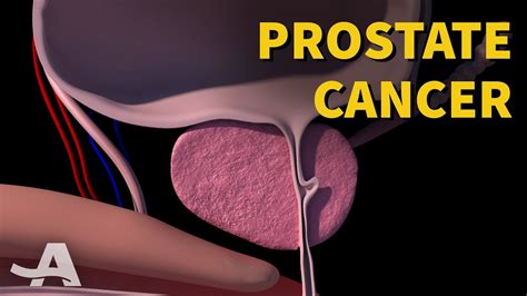 Early Signs Of Prostate Cancer Youtube