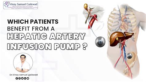 Which Patients Benefit From A Hepatic Artery Infusion Hai Pump Dr