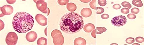 HEMATOLOGIA ALTERACIONES CUALITATIVAS DE LOS LEUCOCITOS