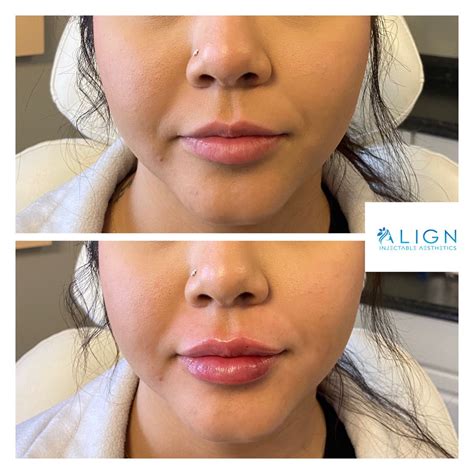 Lip Injection Before After Gallery Artofit