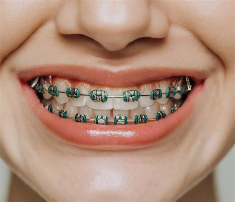 Unveiling The Smile A Comprehensive Guide To Dental Braces Cost In Kenya