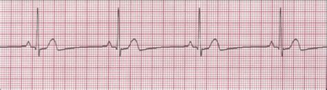 Anat Ii Lab Quiz Ekg Abnormalities Flashcards Quizlet