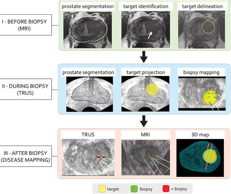 Mr Imagingtransrectal Us Fusion For Targeted Prostate Biopsies Implications For Diagnosis And