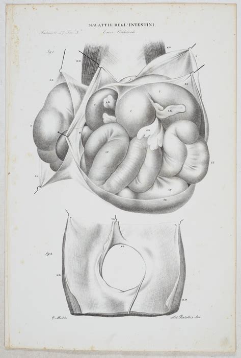 Malattie Degli Intestini Ernie Tafeln Aus Atlante Generale Della