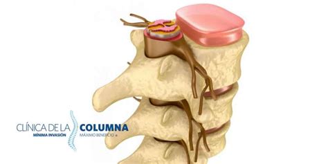 Mielopatía Cervical Espondilótica