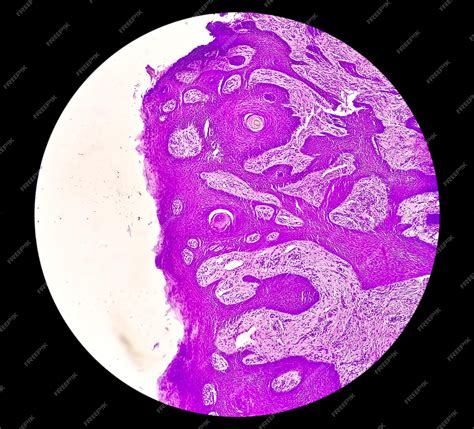 Visão Microscópica Do Carcinoma Basocelular é Um Tipo De Câncer De Pele