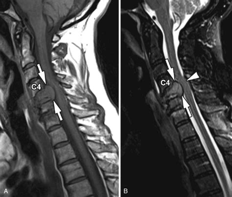 Pathological Fracture Spine