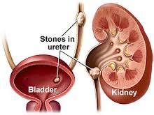 Uric Acid Kidney Stones | Healthcare-Online