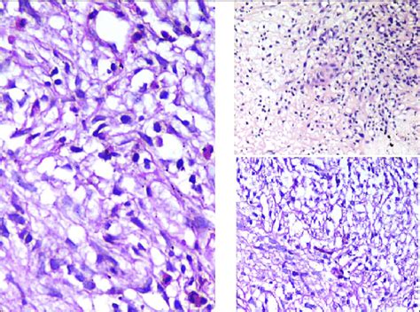 Histopathology Showing Ill Defined Granulomas And Chronic Inflammatory Download Scientific