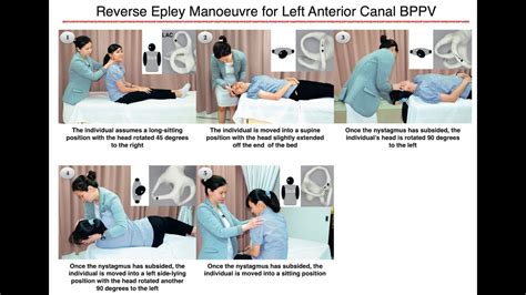 Reverse Epley Manoeuvre For Left Anterior Canal BPPV YouTube