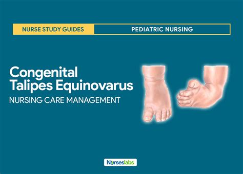 Congenital Talipes Equinovarus Clubfoot Nursing Care Management Nurseslabs